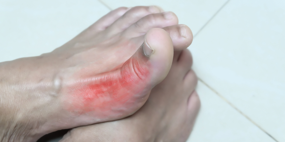 How Long Does Gout Last